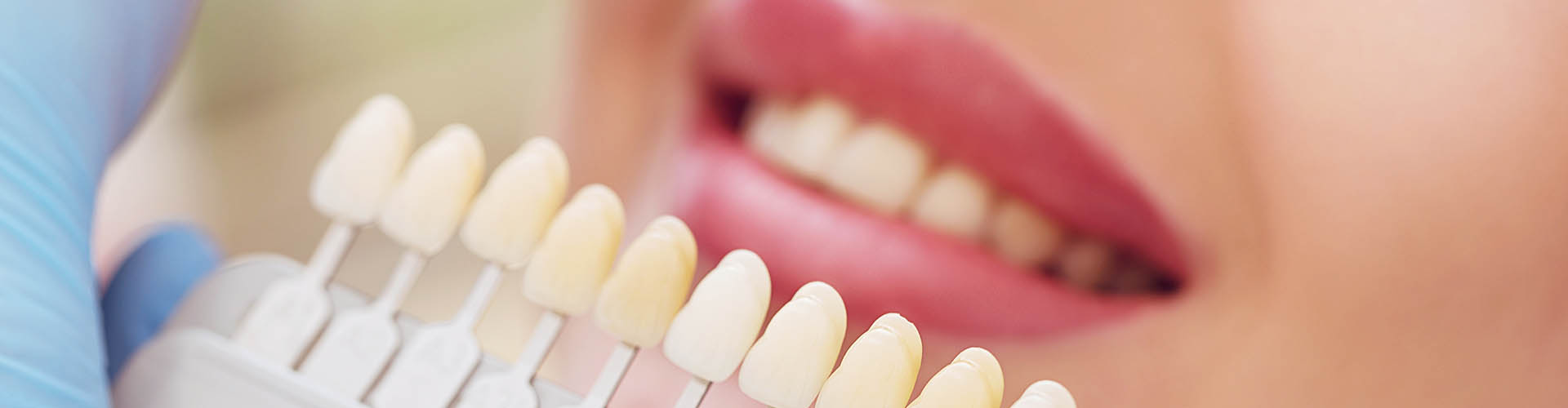 הלבנת שיניים