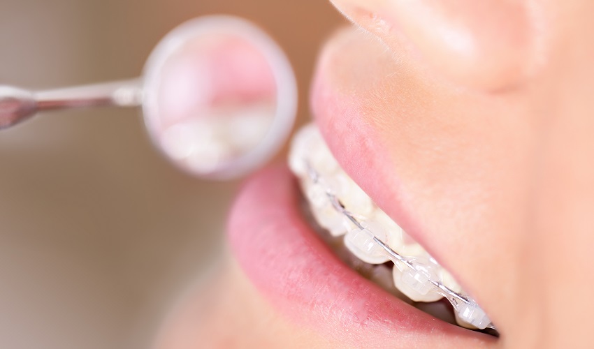 יישור שיניים בשיטה השקופה_1