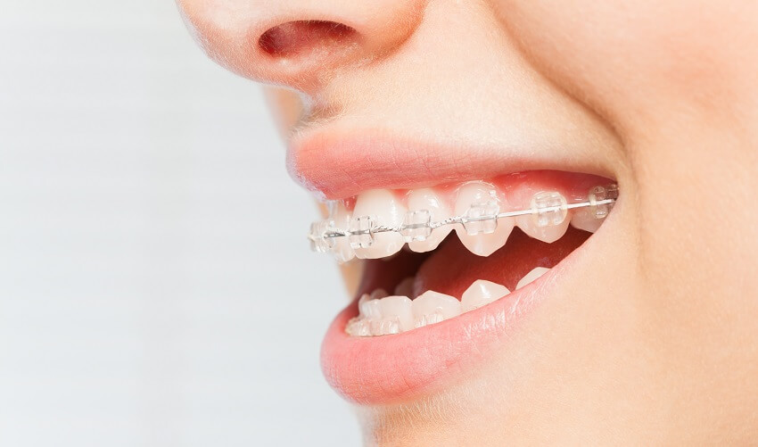 יישור_שיניים_1