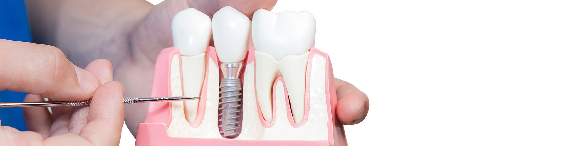 מדריך השוואתי להשתלות שיניים